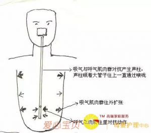 缩小发声点 sls声带边缘化发声