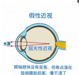 假性近视和真性近视的区别 近视不可恢复绝对是个谎言