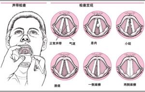 声带小结大了会漏气 声带小结禁声会自愈吗