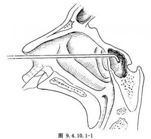 蝶窦共鸣怎么找 蝶窦共鸣歌手