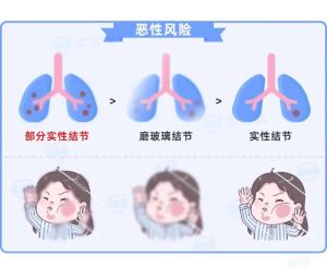 唱歌对肺结节有益吗？健康歌唱的益处与注意事项