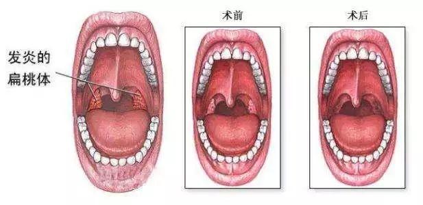 盐水漱口治扁桃体炎有效吗？