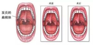 盐水漱口治扁桃体炎有效吗？