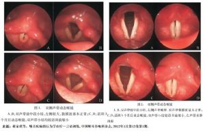 儿童声带小结挂耳鼻喉科治疗