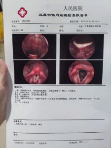 声带小结成因解析与预防措施