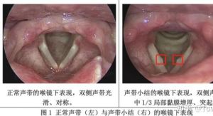 声带损伤自愈可能性及恢复方法