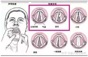 声带受损常见症状及预防措施