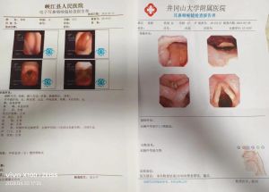 声带息肉：为何不急于切除？详解风险与自然消退可能性