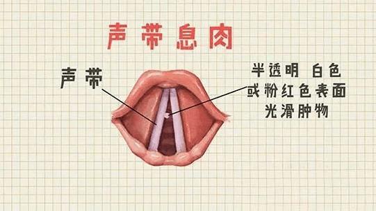 判断声带受损的5大症状及预防建议