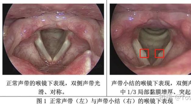 声带损伤可修复？防治攻略全解析