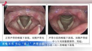 常见声带小结症状及预防措施