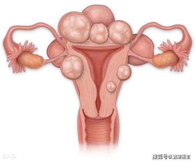 声带肿物恶变风险揭秘