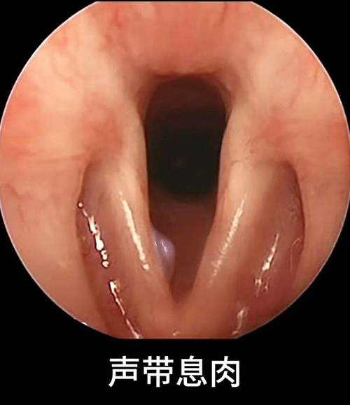 声带息肉微创手术全过程详解