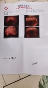 声带小结禁声时长：治疗恢复关键因素