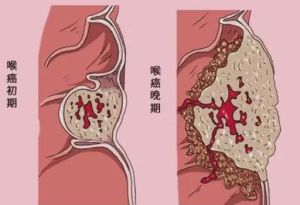 声带嘶哑怎么办？改善声音嘶哑的5大方法