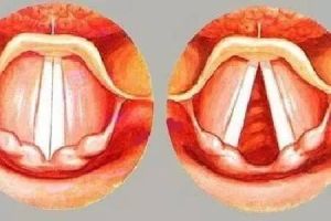 右侧声带麻痹：成因症状与影响详解