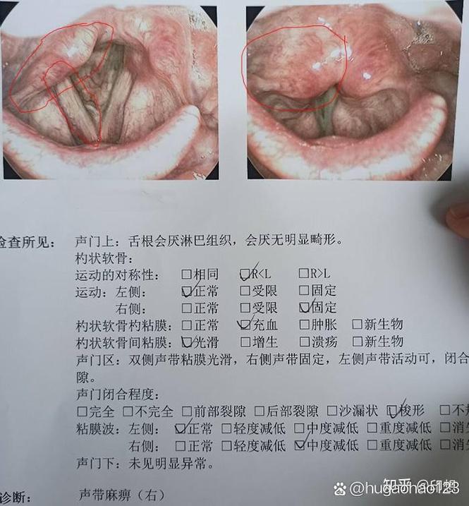 声带麻痹最佳治疗方案全解析