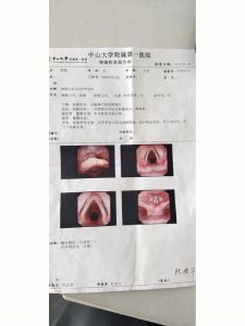 声带息肉术后康复指南与出院须知