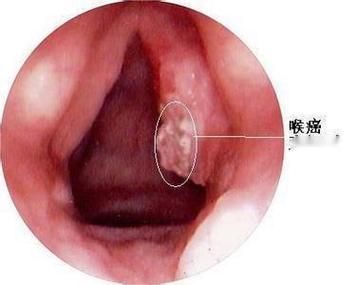 声门闭合不全治疗：药物声音手术与生活调适指南