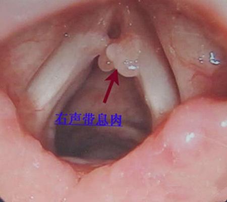 声带小结与声音嘶哑：关系揭秘及预防措施